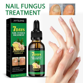 🎁 (Lleva 2 x 1) 🎁Nail Treatment - Tratamiento de hongos para las uñas